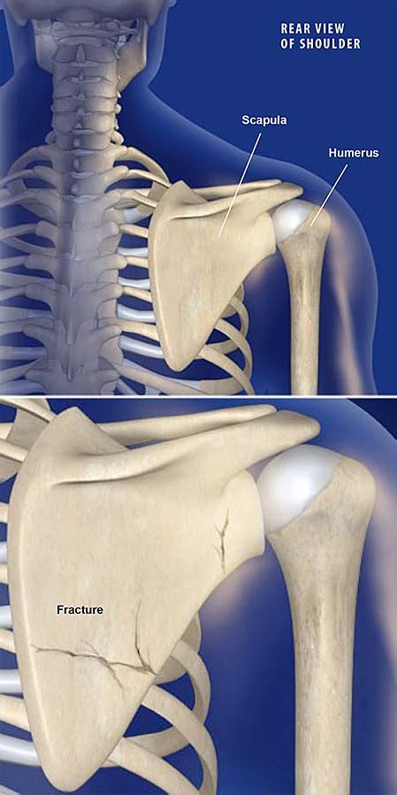 shoulder blade scapula fracture